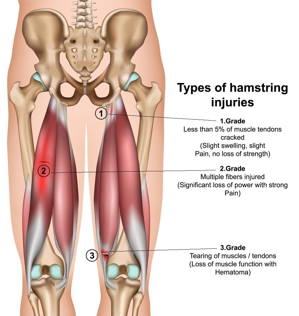 The different types of hamstring injuries