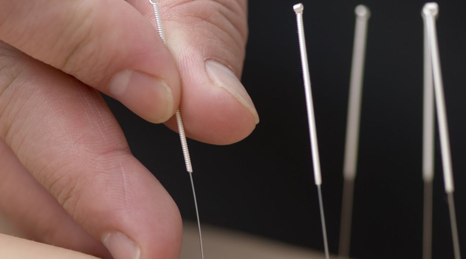 Medical Acupuncture Medical Acupunture