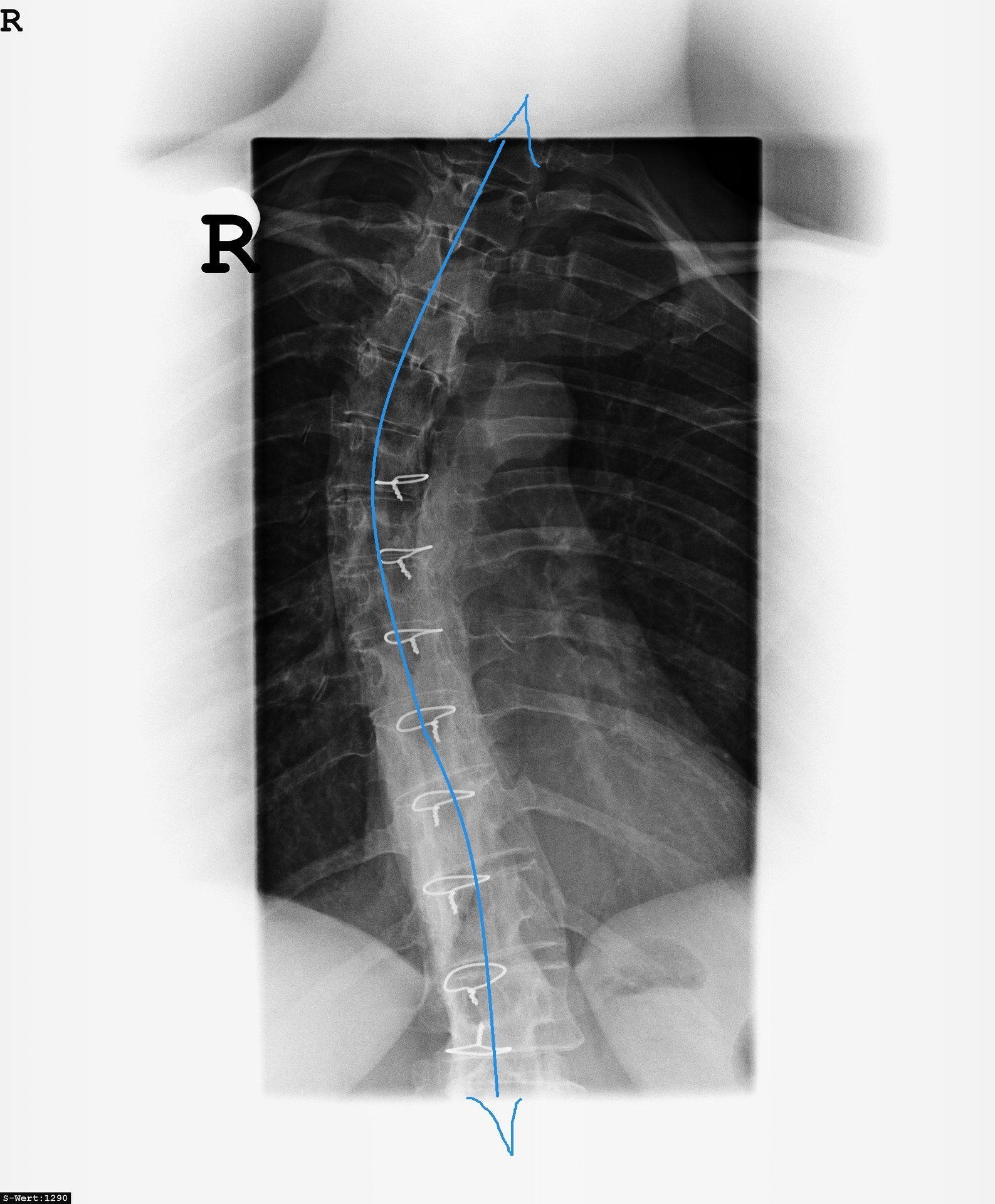 scoliosis of the lower back