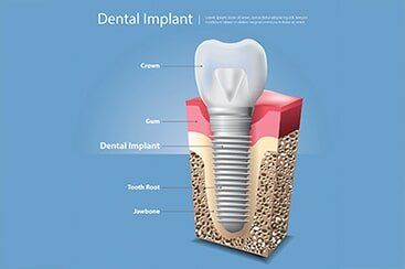 Human teeth and Dental implant 