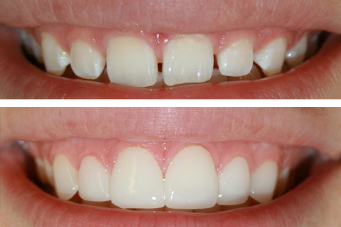 veneer dental services in QLD