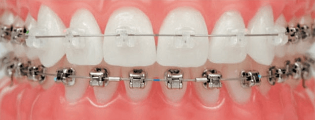 Braces after our orthodontic services near Cleveland