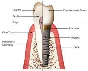 An image showing how dental implants are put in by a dentist serving Redlands
