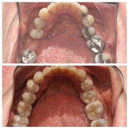 dental fillings services in QLD