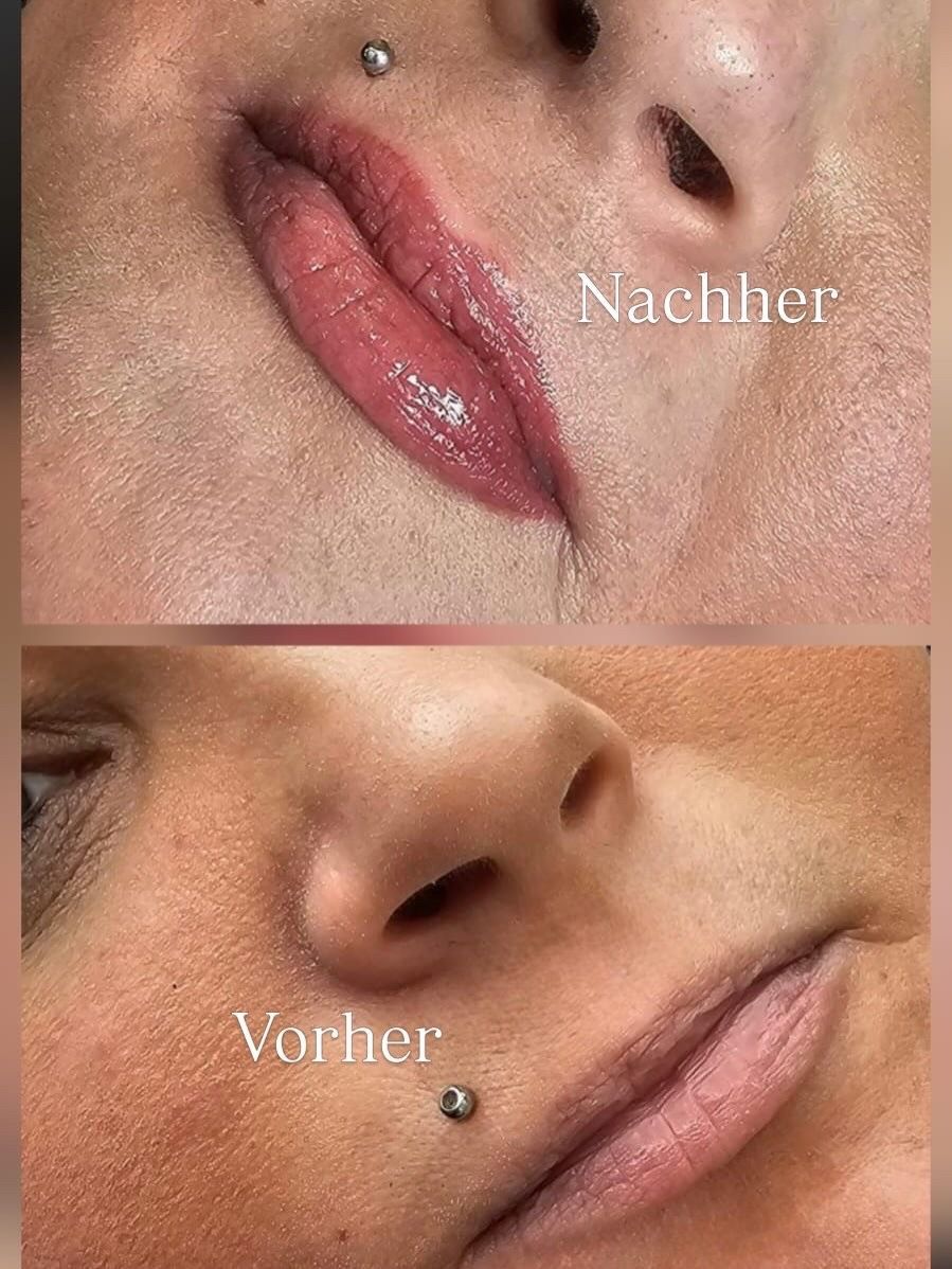 Nahaufnahme der Lippen vor und nach der Fillerbehandlung, die ein volleres, rosiges Lippenergebnis zeigt.