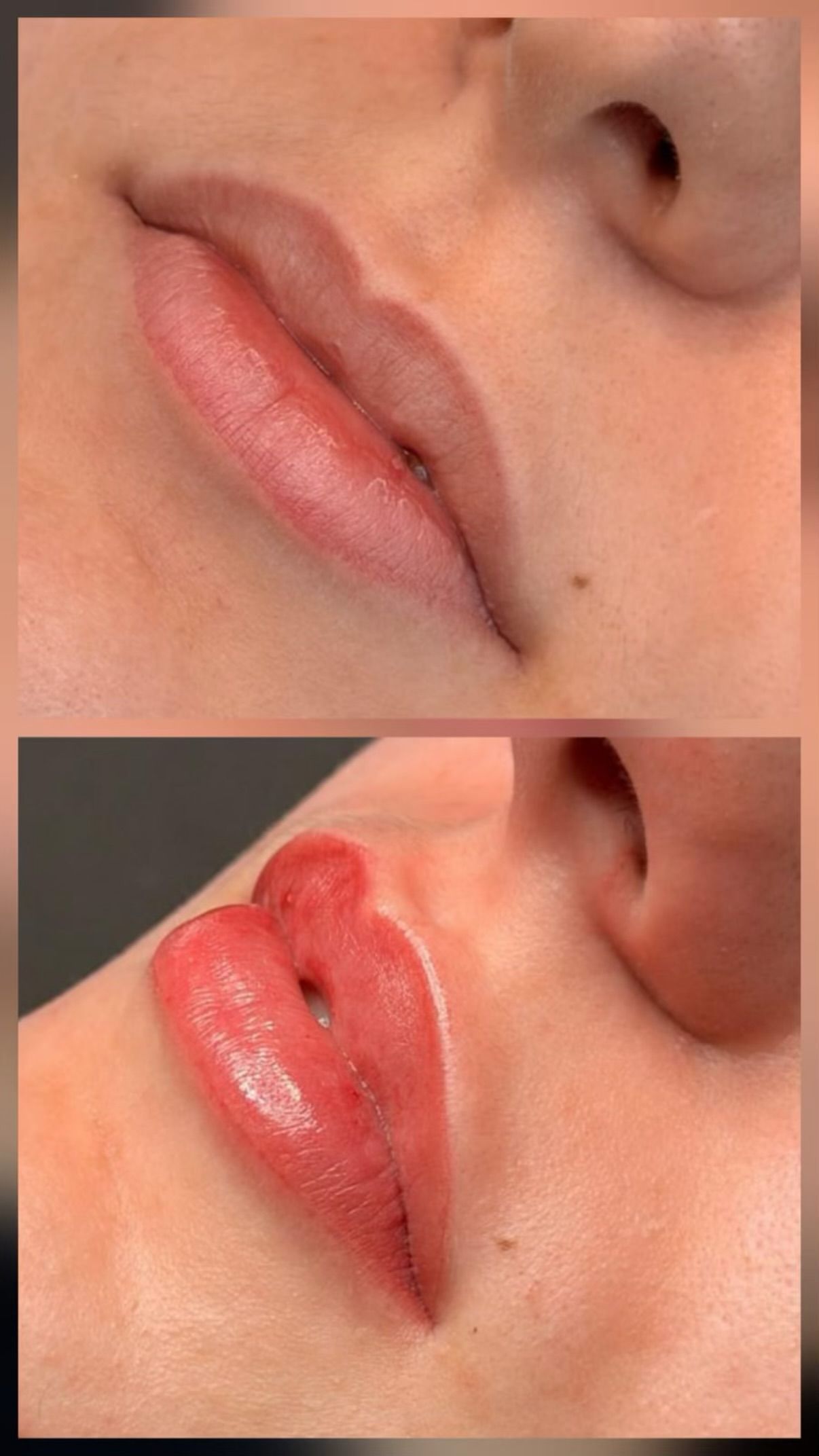 Nahaufnahme der Lippen; oben ist eine trockene Lippe zu sehen, unten eine heilende, gerötete Schnittwunde mit Salbe.