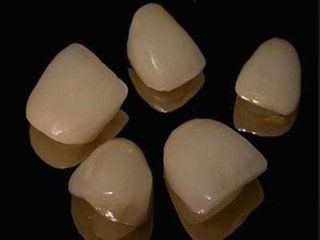 Faccette Estetiche Dentali Nocera (Salerno) - Studio Dentistico Senatore