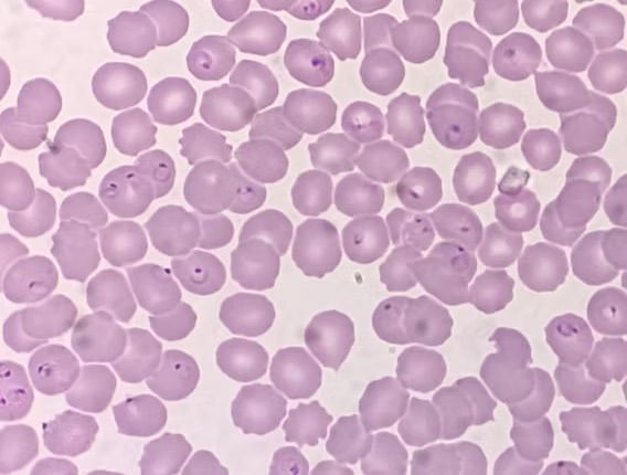 Mikroskopische Ansicht eines Blutausstrichs, der zahlreiche rote Blutkörperchen zeigt mit ringförmige Malariaparasiten.