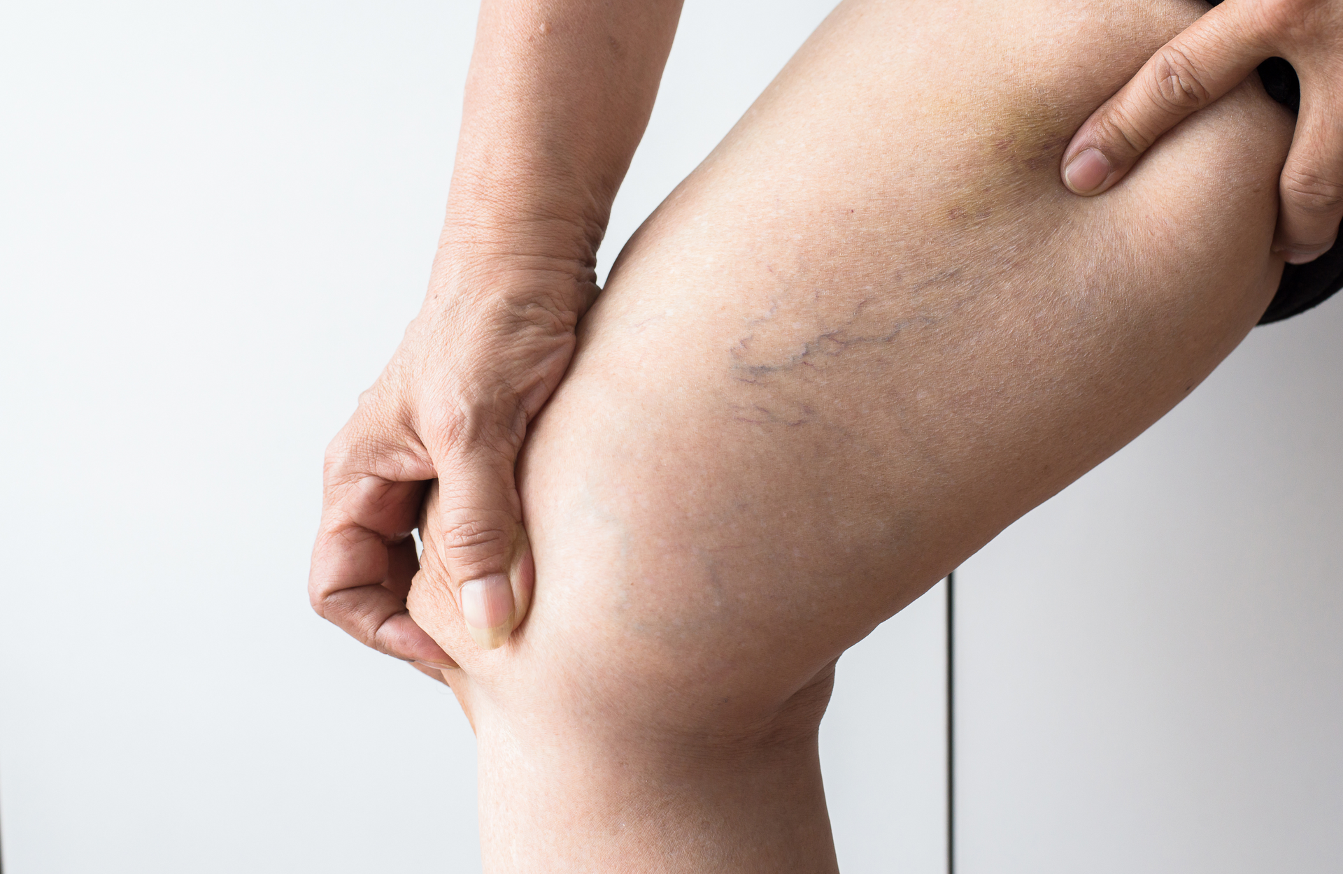 A woman is holding her leg with varicose veins on it.