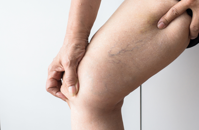 A woman is holding her leg with varicose veins on it.