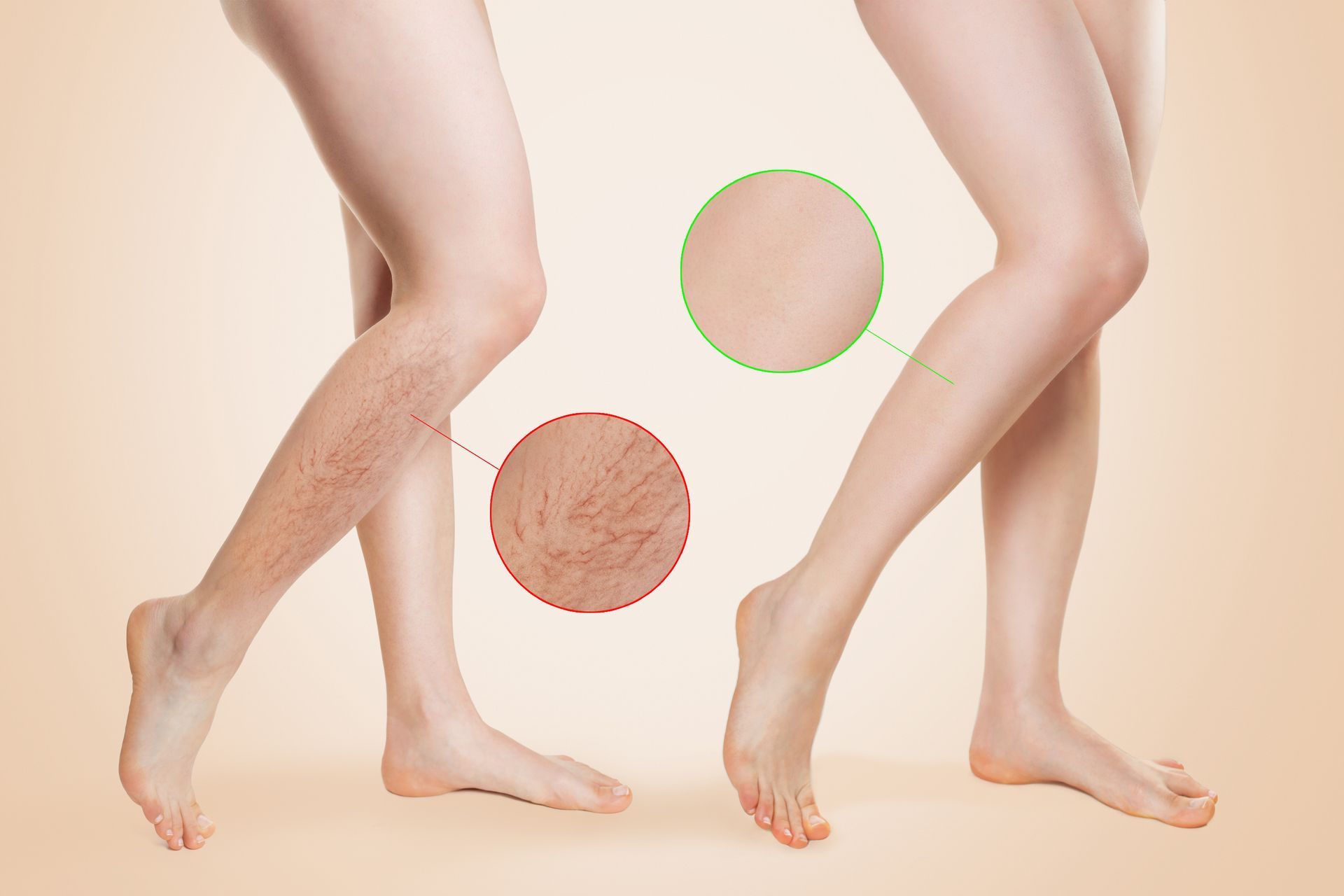 Woman's legs; Enlarged circles show healthy and unhealthy veins. Beige background.