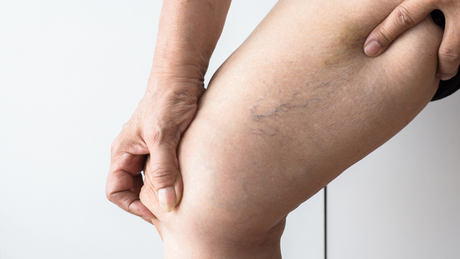 A woman is holding her leg with varicose veins on it.