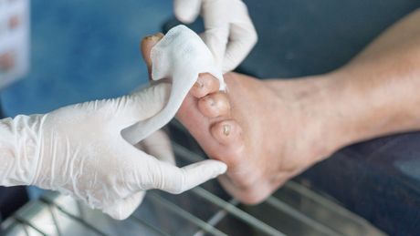 A doctor is cleaning a patient 's foot with a cotton swab.