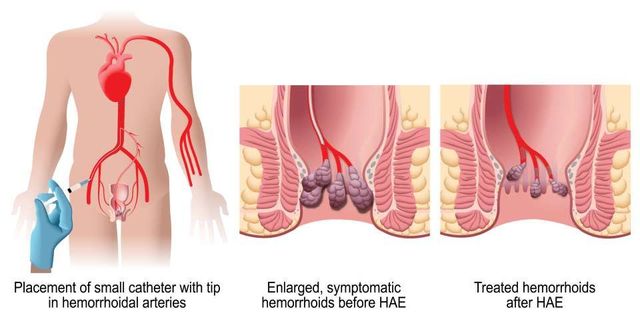 semaglutide and hemorrhoids Endovascular Hemorrhoid Treatment
