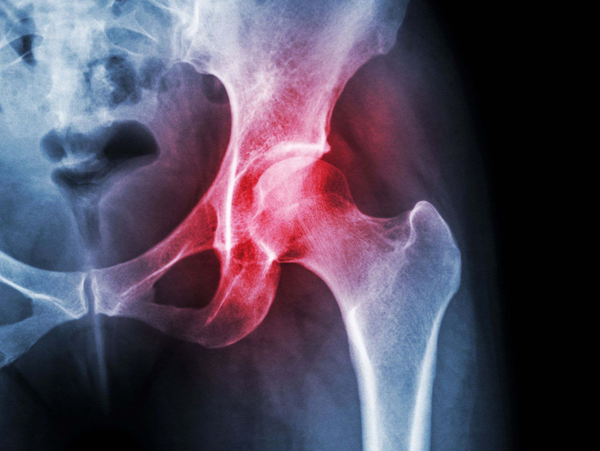 Displasia congenita dell'anca