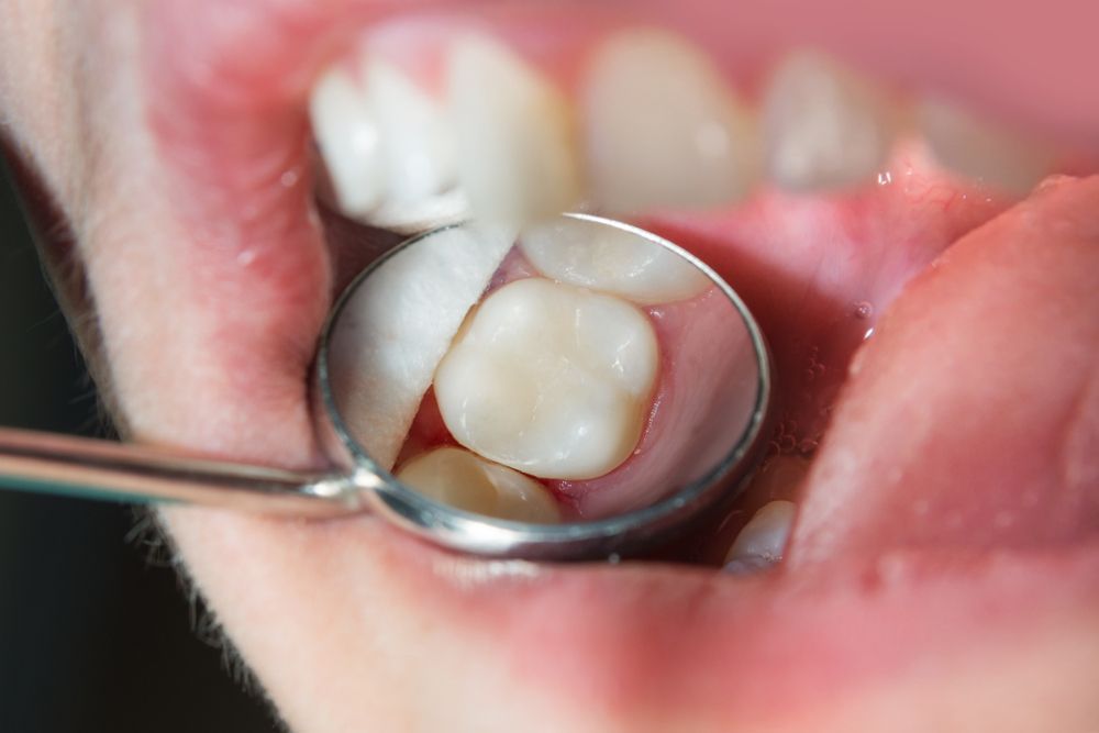 Close Up of Human Rotten Carious Tooth at the Treatment Stage — Aspire Dental in Townsville, QLD
