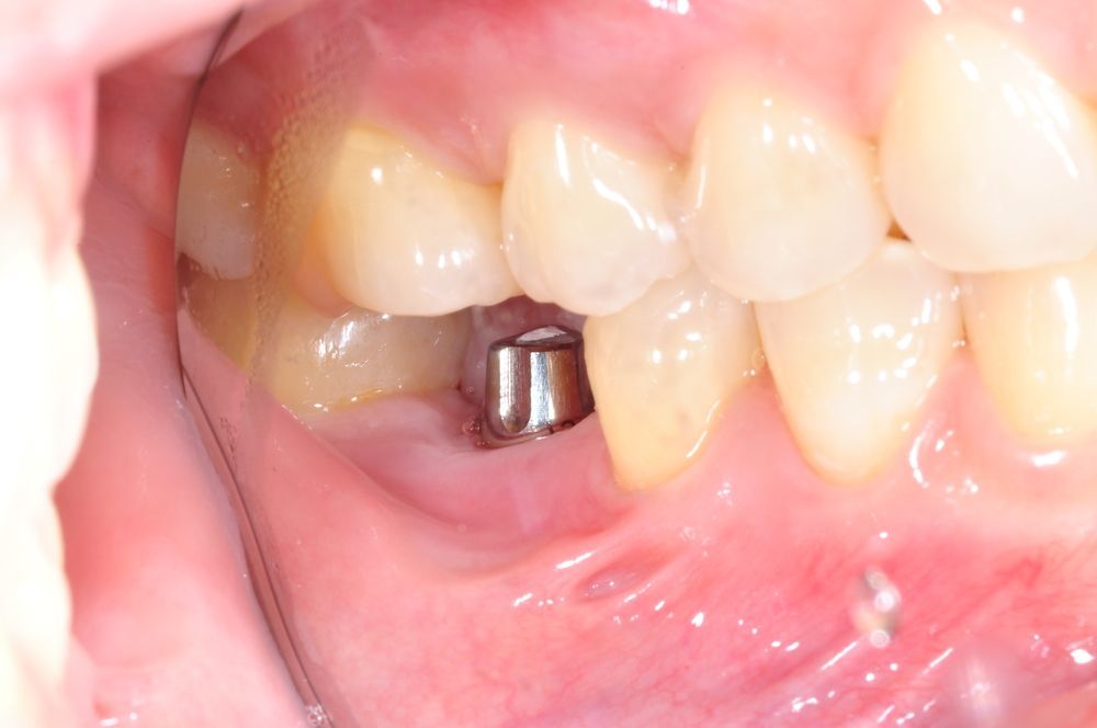 A Close Up Of A Persons Mouth With A Tooth Implant — Aspire Dental in Townsville, QLD