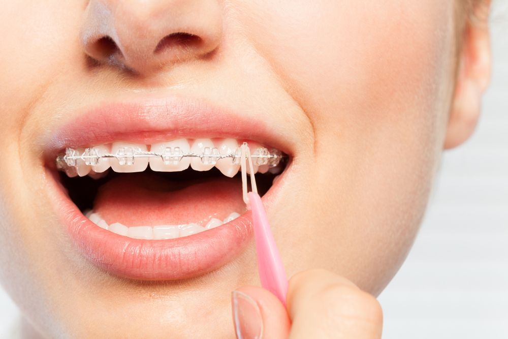 A Woman With Braces Is Flossing Her Teeth With A Pink Toothbrush — Aspire Dental in Kirwan, QLD