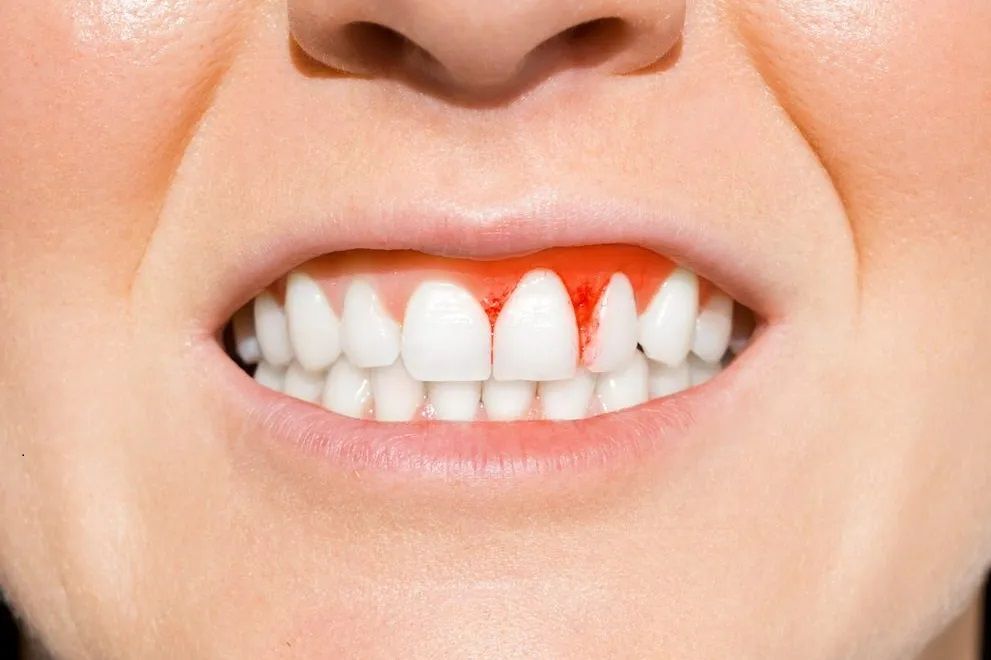 Why Do My Gums Bleed When I Brush My Teeth Aspire Dental