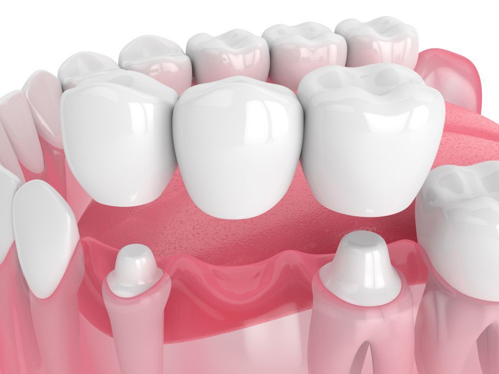 An Image Of A Dental Bridge Between Two Teeth — Aspire Dental in Townsville, QLD