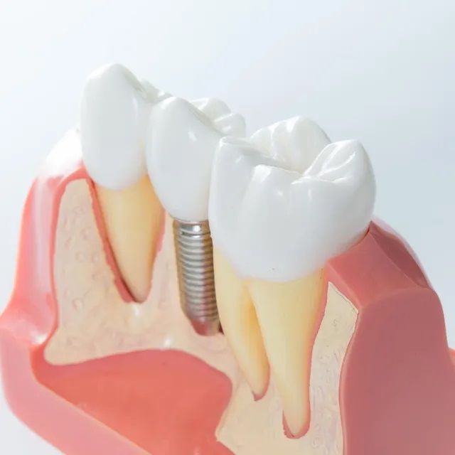 Dental Implant Model - Dentist in Townsville, QLD