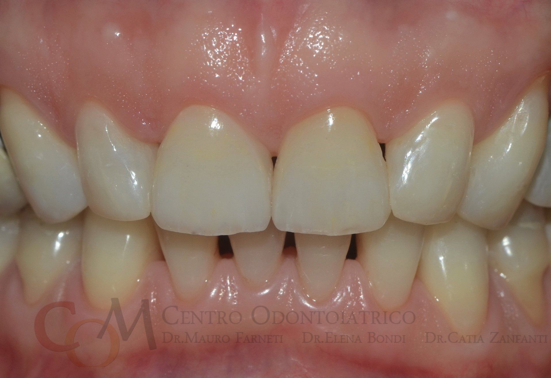 Primo piano dei denti frontali superiori e inferiori, che mostra uno spazio tra gli incisivi centrali superiori.
