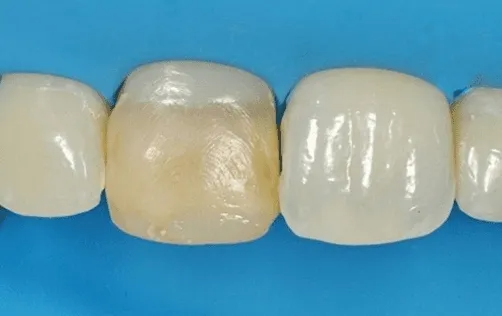 Primo piano di tre denti frontali, tra cui un dente scolorito di giallo, su sfondo blu.