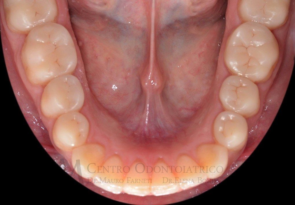 Primo piano dell'arcata dentale inferiore e della lingua, che mostra molari e gengive in una vista clinica della bocca.