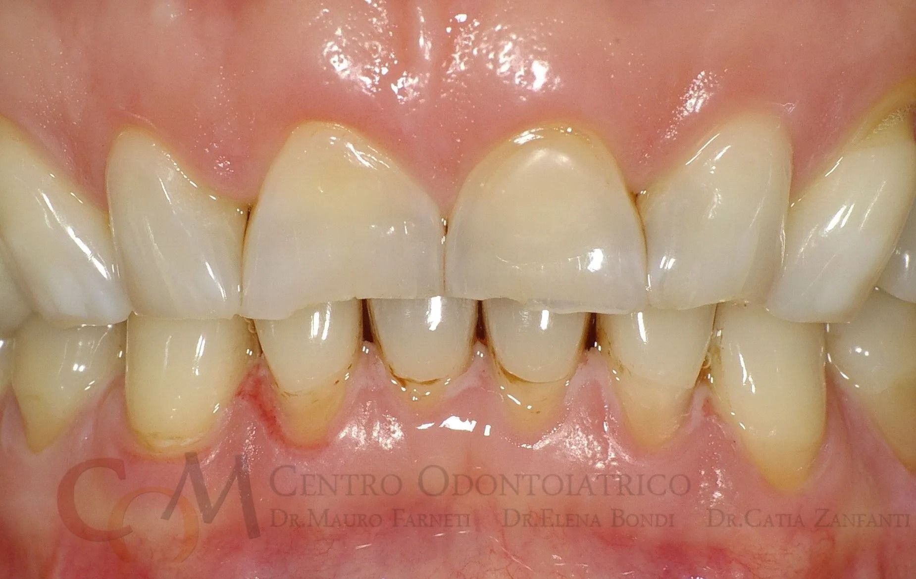 Primo piano di denti con evidenti spazi e disallineamenti, che mostrano gli incisivi superiori e inferiori.