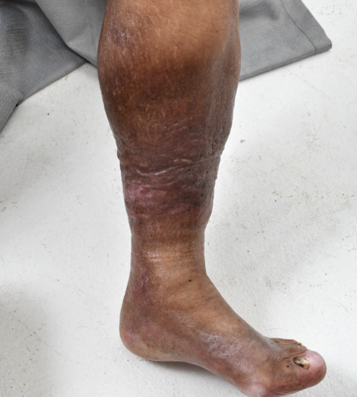 Leg with discolored, possibly injured skin. Light skin tone with dark, patchy areas.