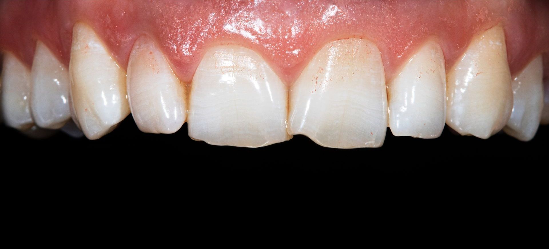 Dental Implant Before