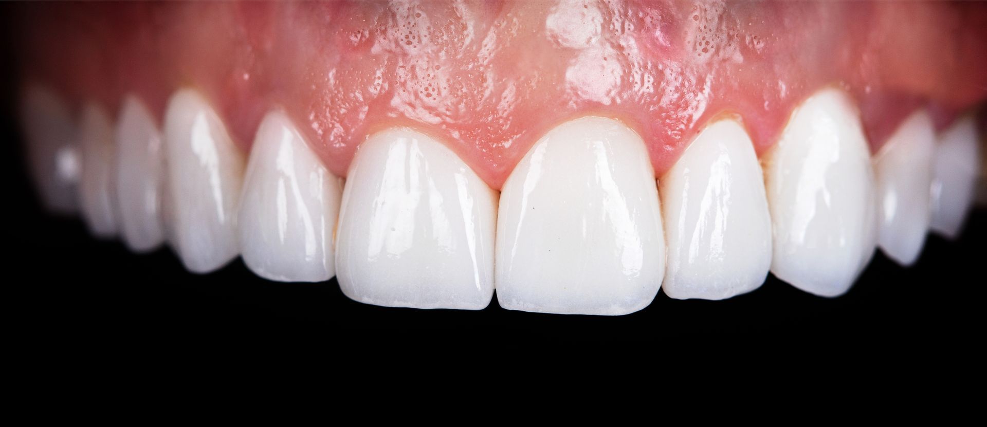 Dental Implant After