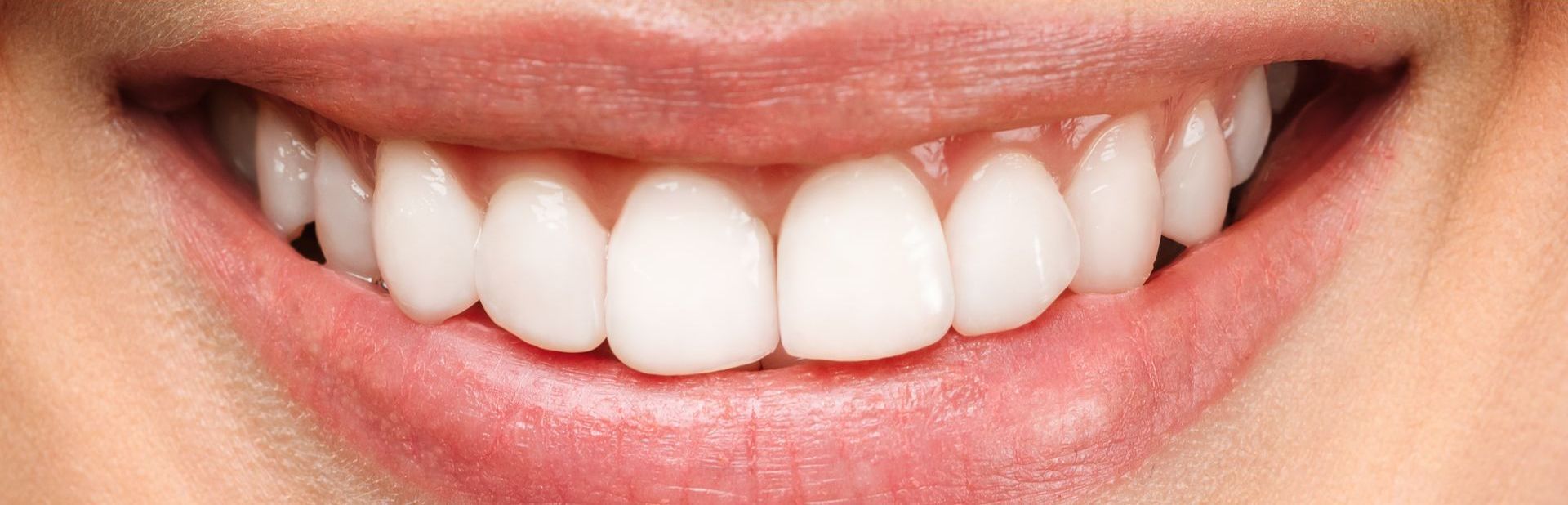 Teeth Whitening After