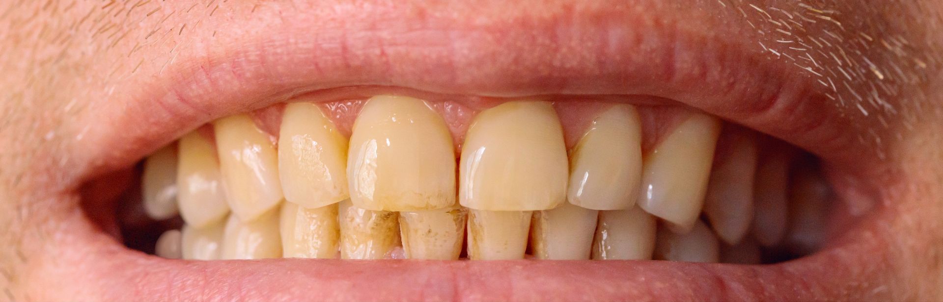 Teeth Whitening Before