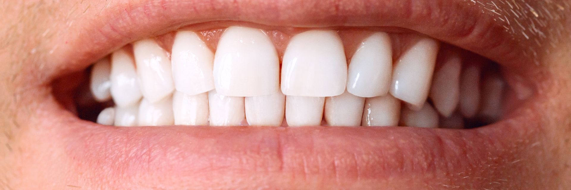 Teeth Whitening After