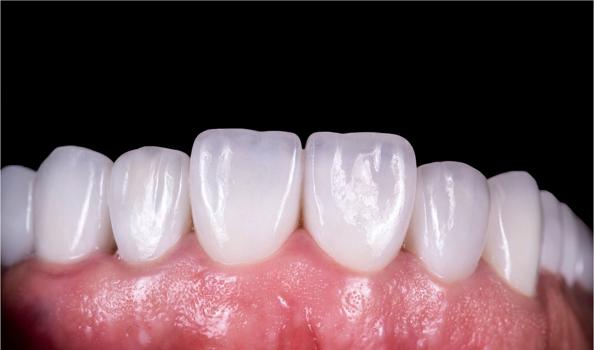 Dental Implant After