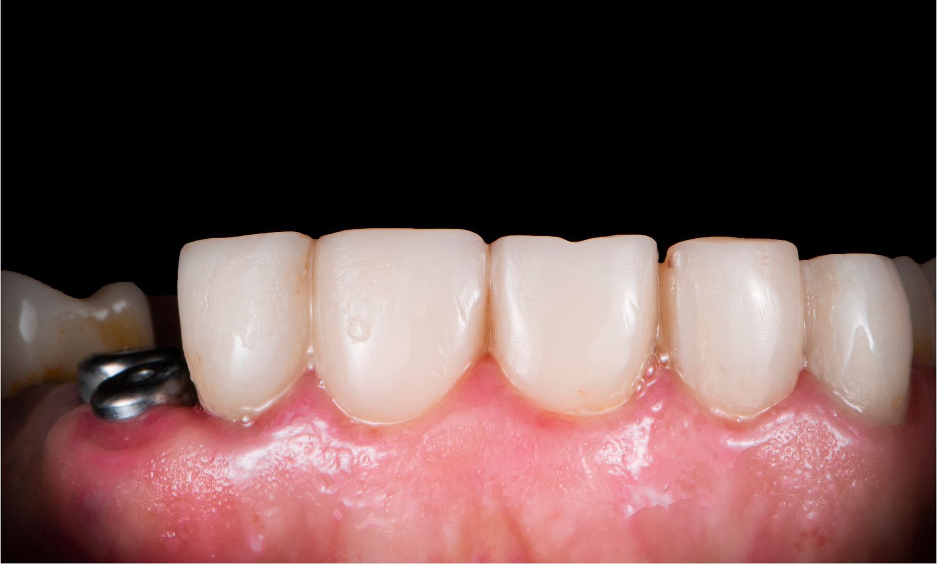 Dental Implant Before