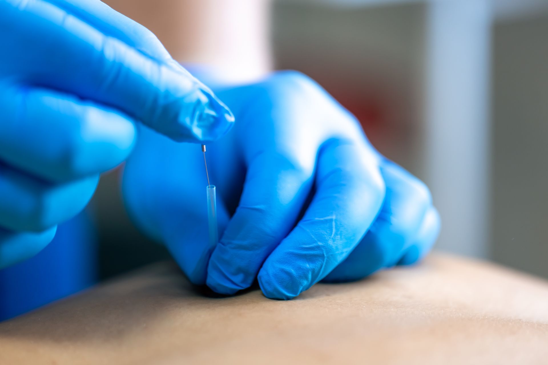 Hands in blue gloves holding acupuncture needle, inserting it into skin.