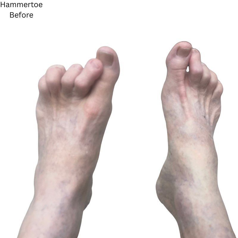 Two bare feet showing hammertoe deformity, before treatment.