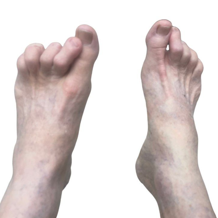 Two bare feet showing hammertoe deformity, before treatment.