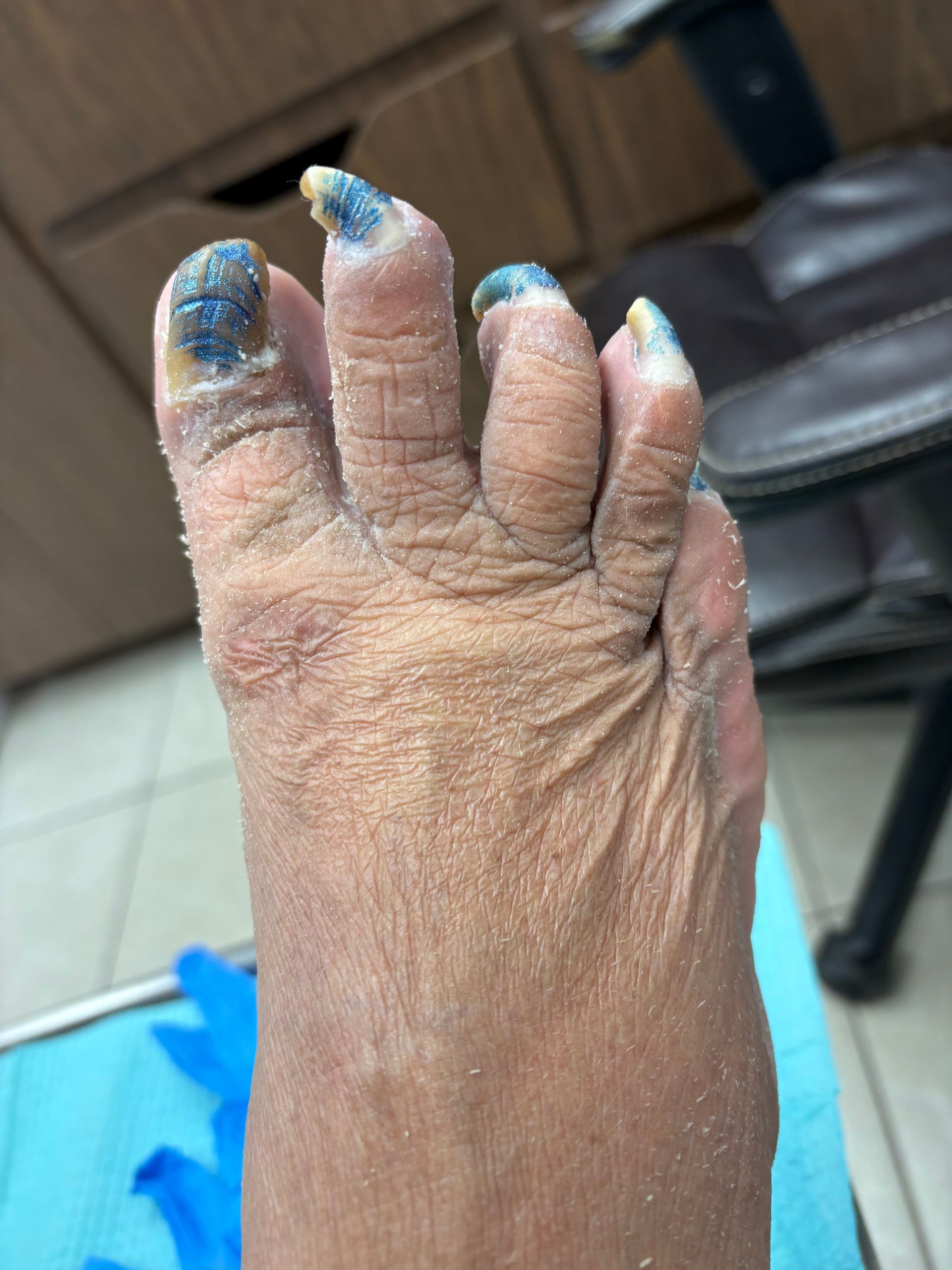 Two bare feet showing hammertoe deformity, before treatment.