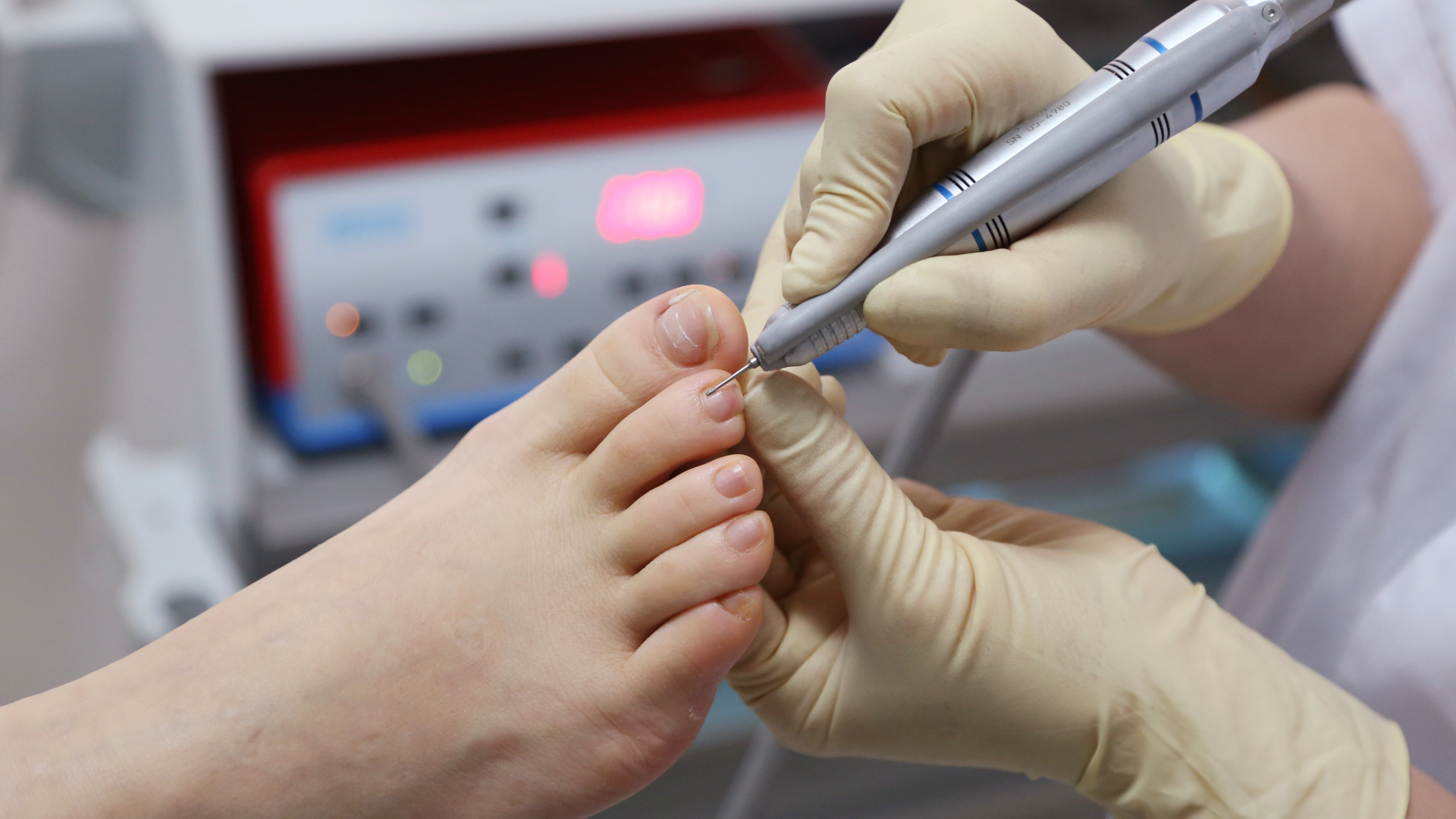 A person's foot being worked on by a podiatrist using a medical drill. The podiatrist wears gloves.
