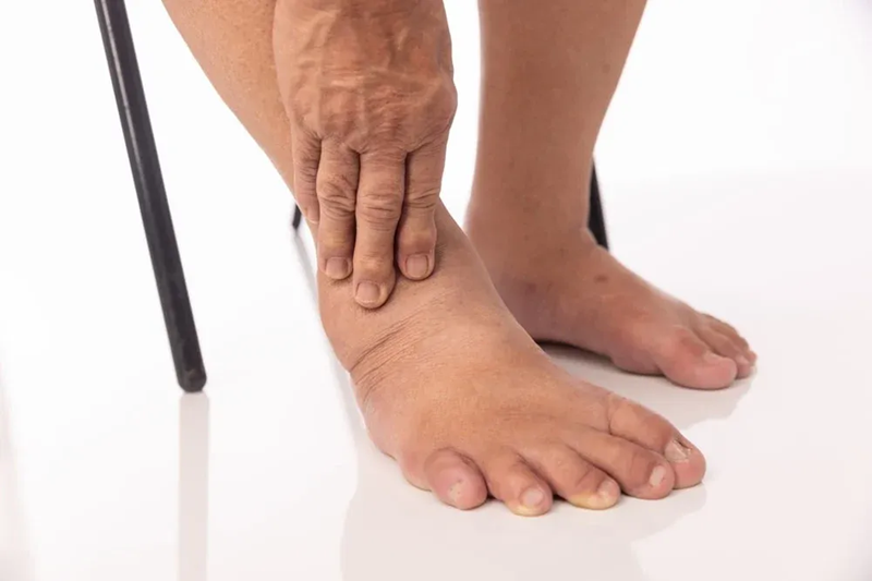 Person's swollen foot and ankle. Hand is touching ankle. White background.