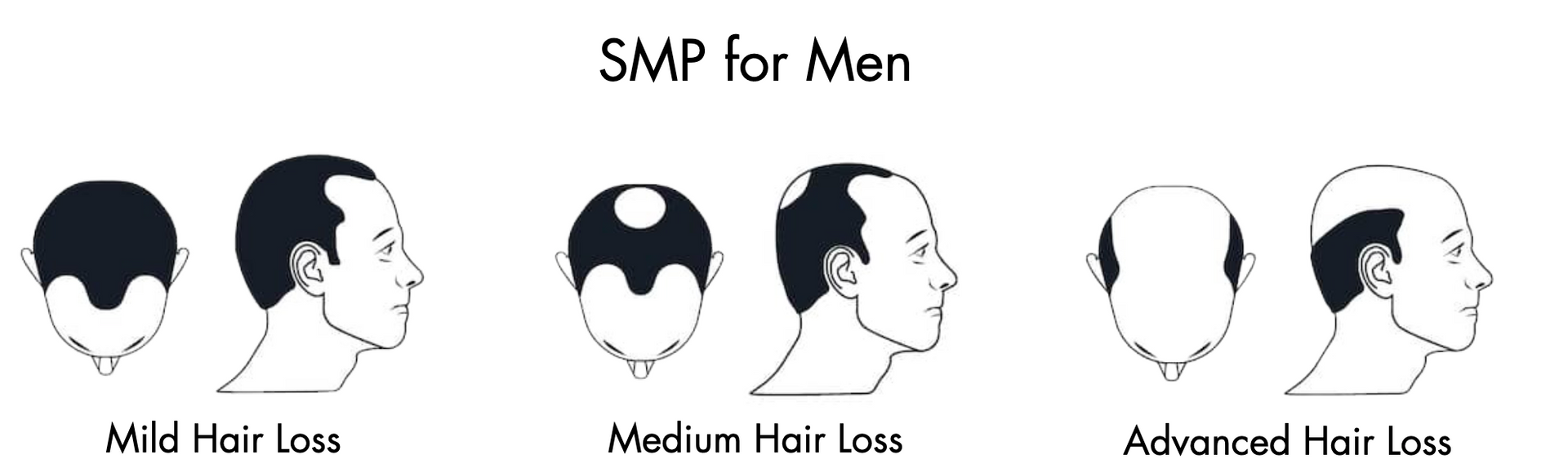 A diagram showing different types of hair loss for men