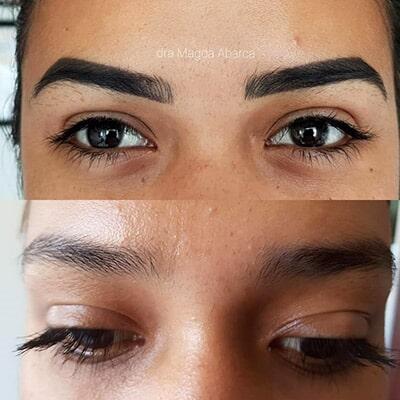 Mediestética Acapulco - peeling facial