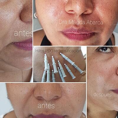 Mediestética Acapulco - radiofrecuencia facial
