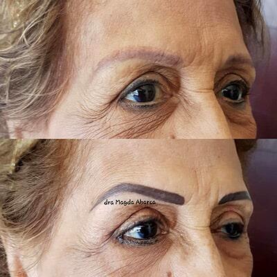 Mediestética Acapulco – botox