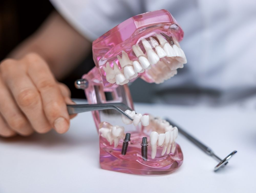 A person using dental tools on a plastic model of teeth, highlighting implants.