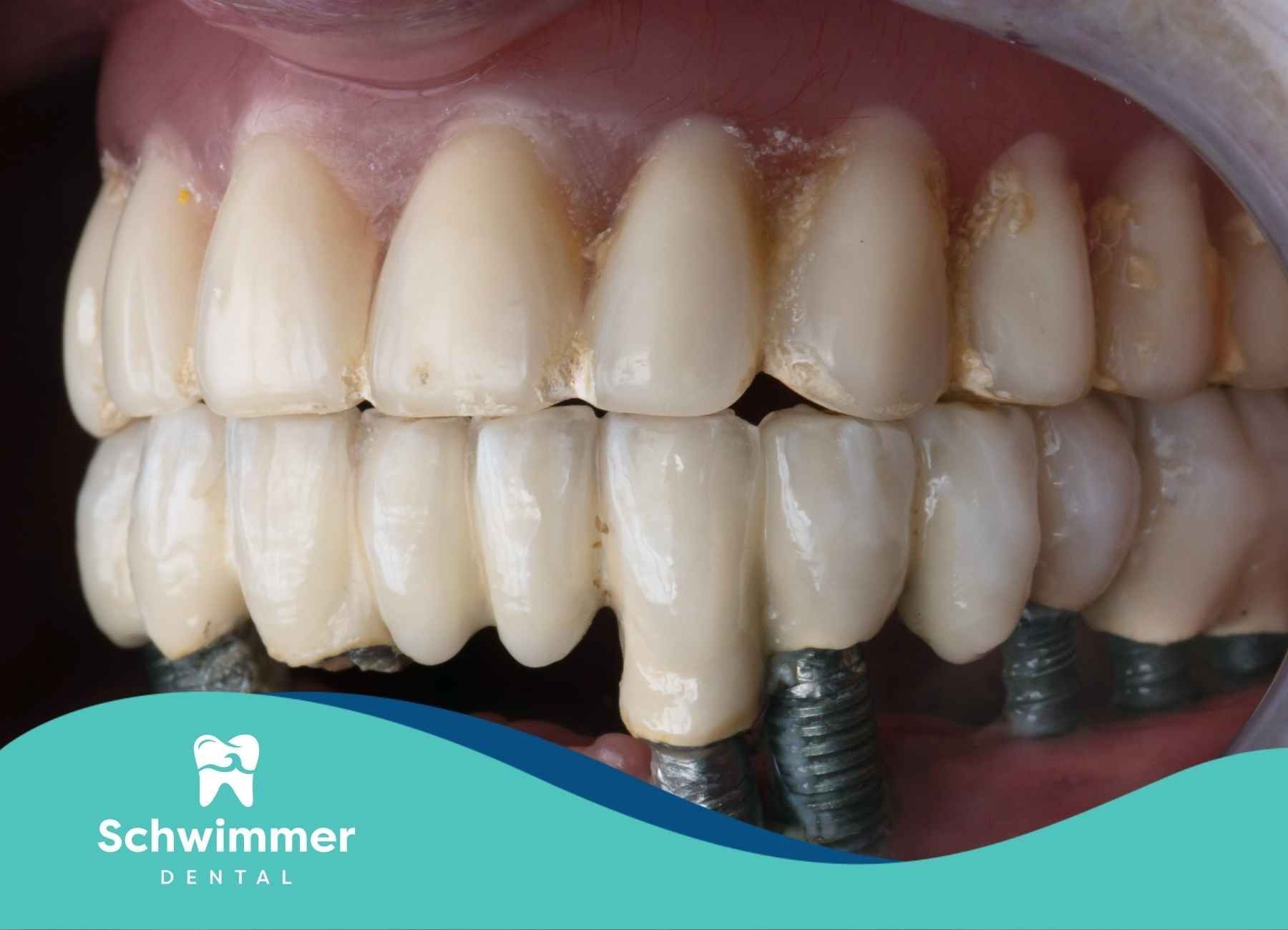 A close up of a person's teeth with dental implants.