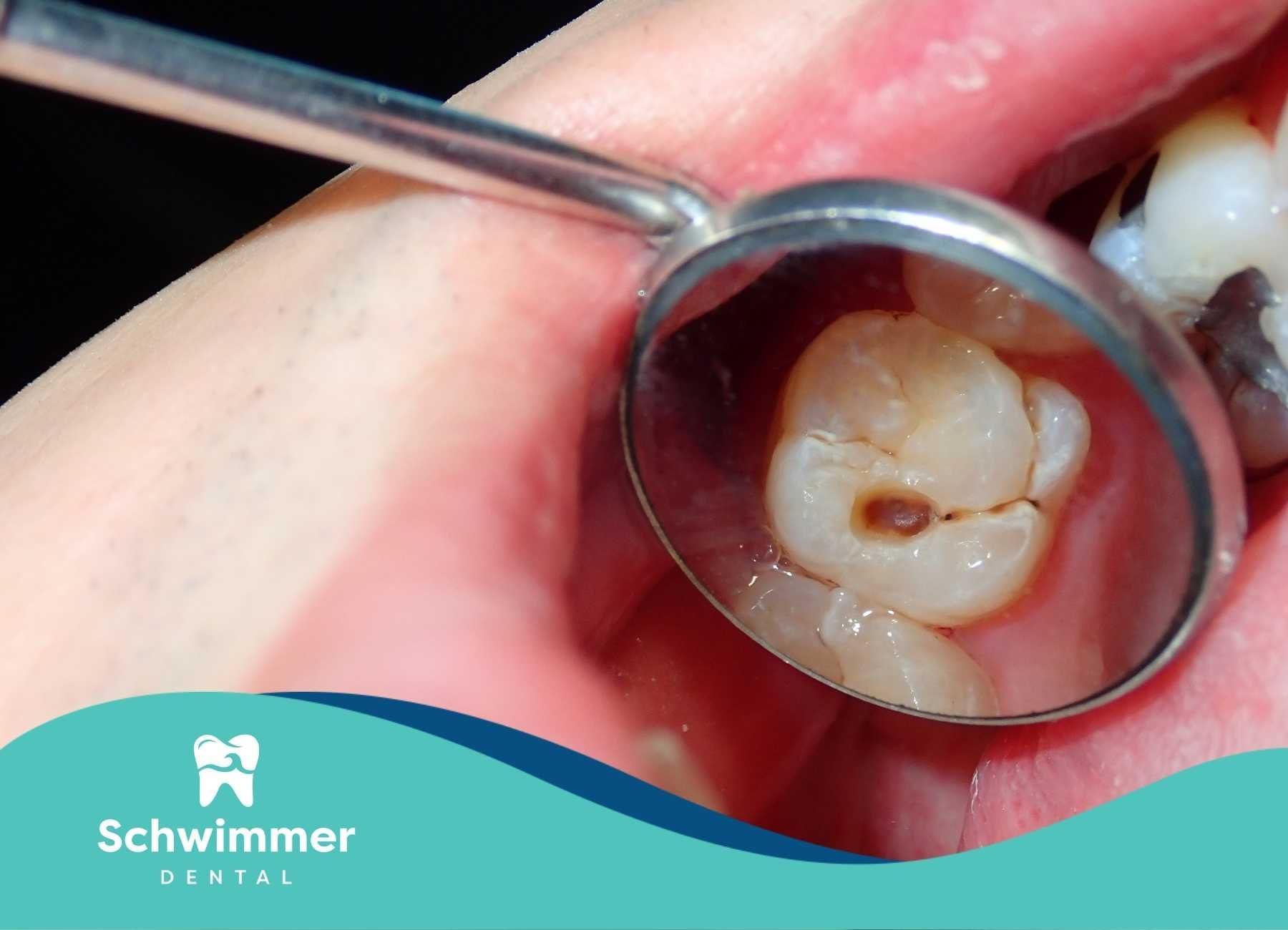 A dentist's mirror shows a close-up of a molar with a dark cavity and a small crack.
